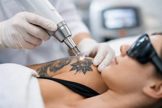 Picolaser tatuoinnin poisto - mitä odottaa
